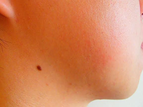 ほほひげ脱毛後