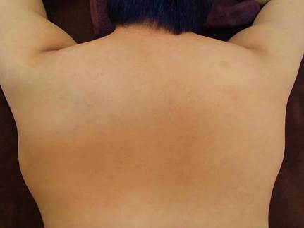背中上脱毛後