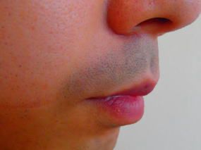 鼻下ひげ脱毛前