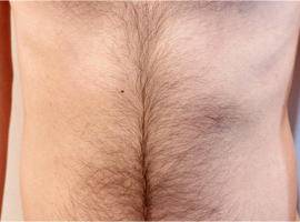 腹毛脱毛前